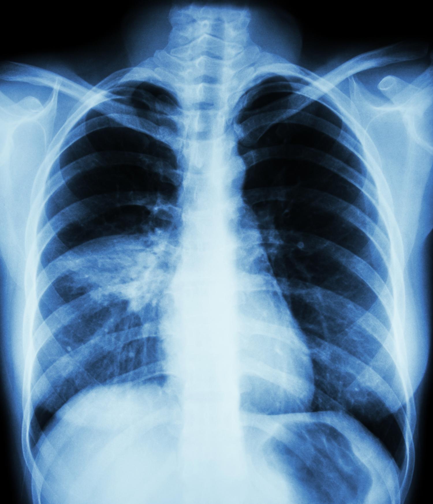 Атипичная пневмония рентген