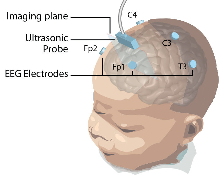 Отек мозга у новорожденных. Мозг новорожденного ребенка. Развитие мозга новорожденного. Картинки для развития мозга новорожденного. Устройство мозга грудного ребенка.