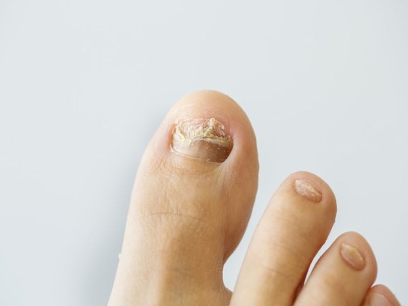 Fungal Nails: What are the Treatment Options - Foot And Ankle