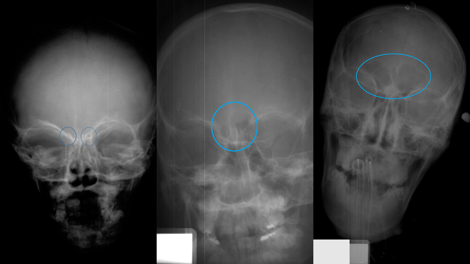 Окостенение костей черепа рентген