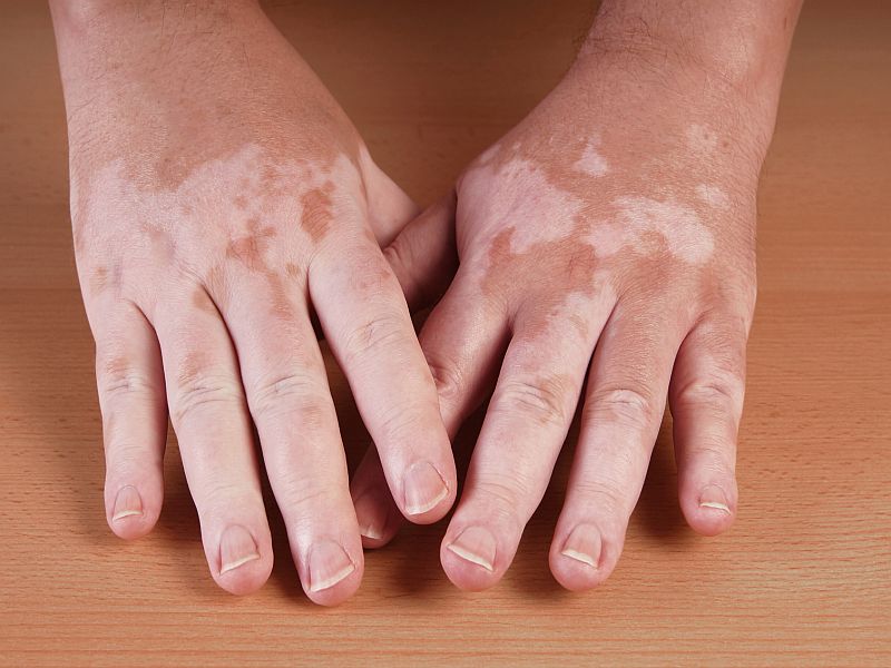 Limited economic evidence for vitiligo treatments