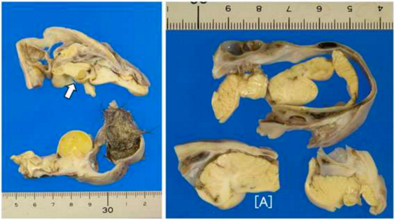 Partially developed brain found in young girl's ovary