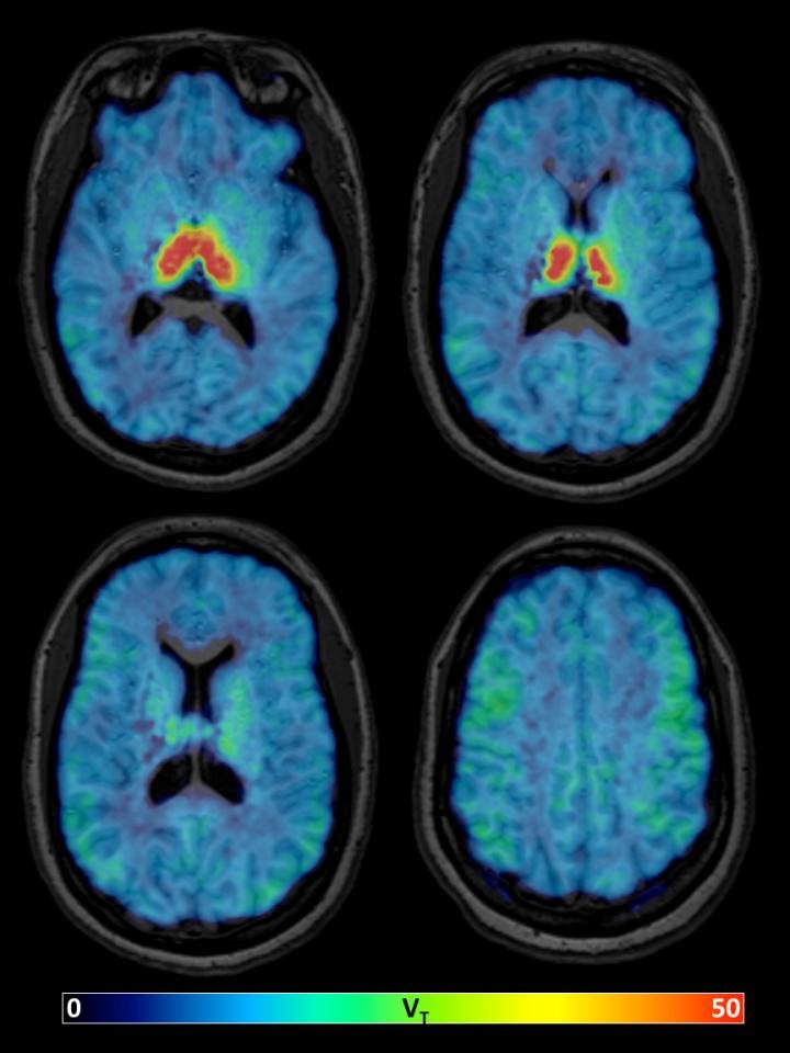 Largest Brain Study of 62,454 Scans Identifies Drivers of Brain Aging