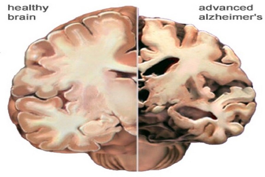 what-really-causes-alzheimer-s-and-how-might-we-fix-it