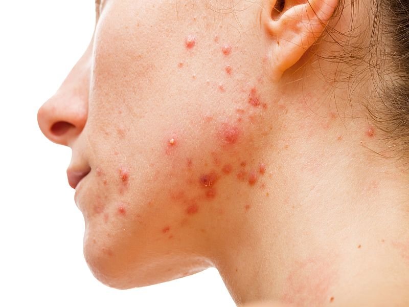 How to take action against acne