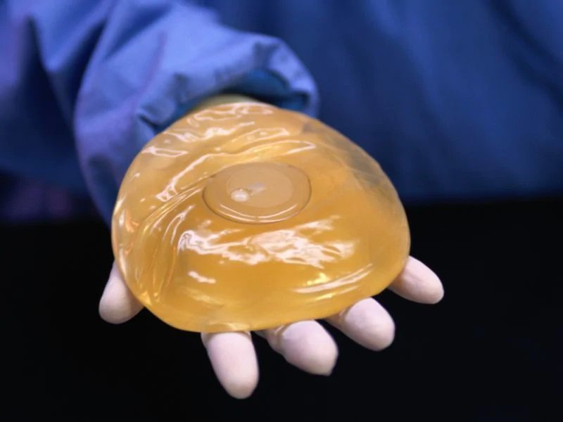 Long Term Outcomes Of Breast Implants Explored