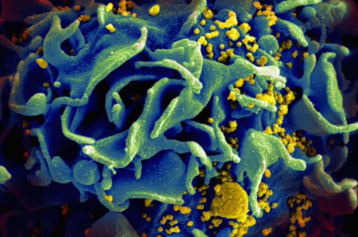 Es más probable que la muerte cardíaca súbita esté infectada con el VIH