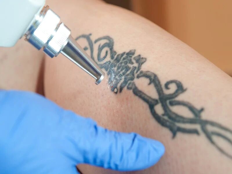 Bad reaction from a new tattoo? Here's what to do