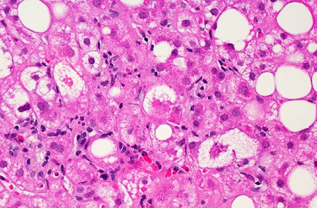 Какие клетки в печени. Матовостекловидные гепатоциты. Клетки печени. Здоровые клетки печени. Клетки печени гепатоциты.