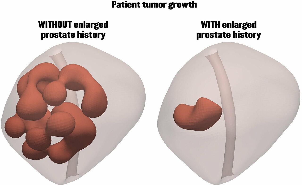 how to reduce prostate enlargement naturally