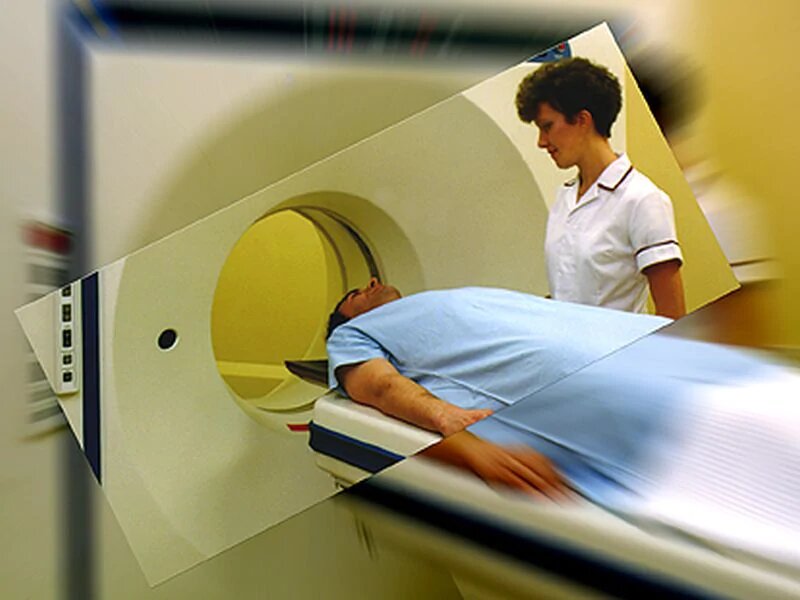 radiotherapy causes lung cancer