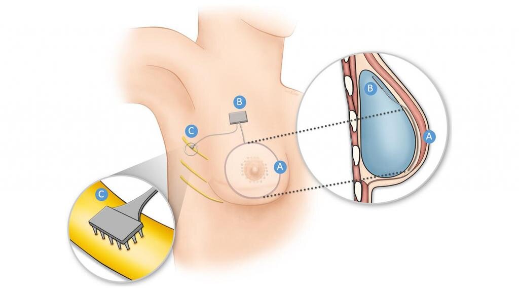 How researchers are restoring sensation via implant to breast