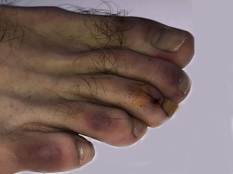 COVID Toes - How This Surprising COVID-19 Symptom Can Impact Skin