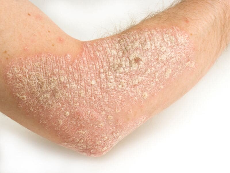 Sex Gender Differences In Psoriasis May Have Clinical Implications 