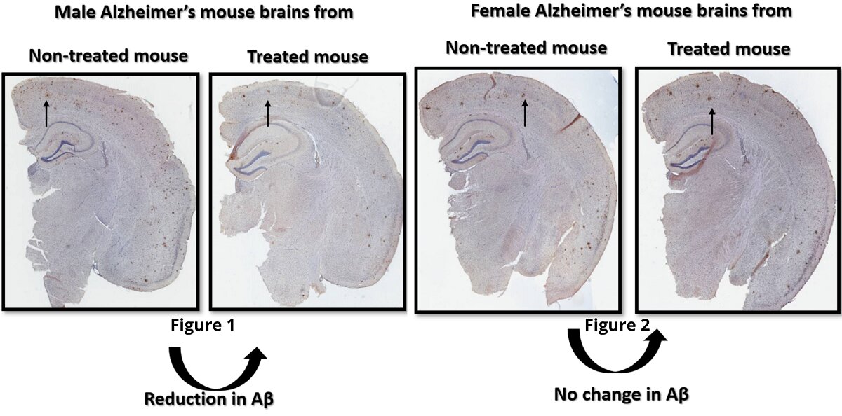 Sex Specific Alzheimers Treatment Could Benefit Males Over Females