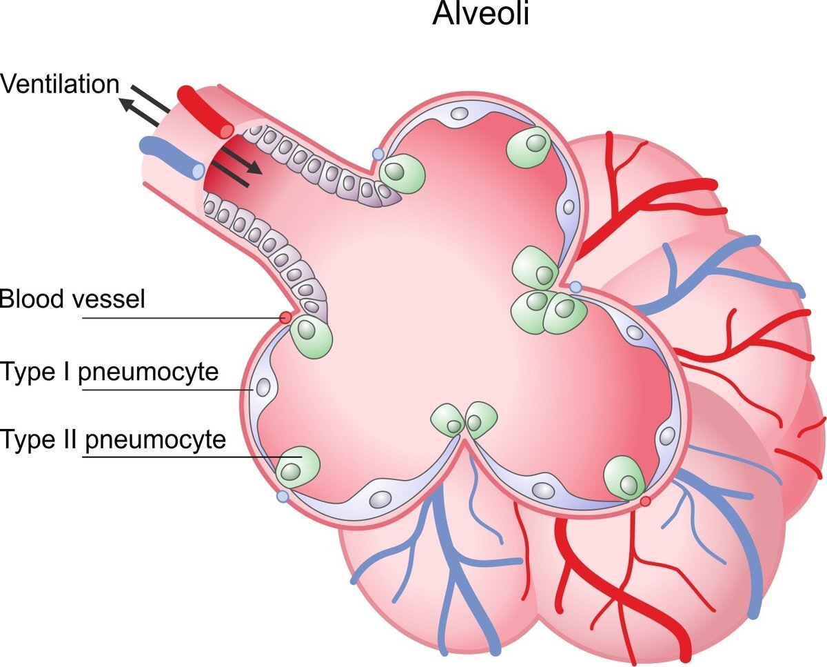 The Sars-CoV-2-Virus can attach on type II pneumocytes. 