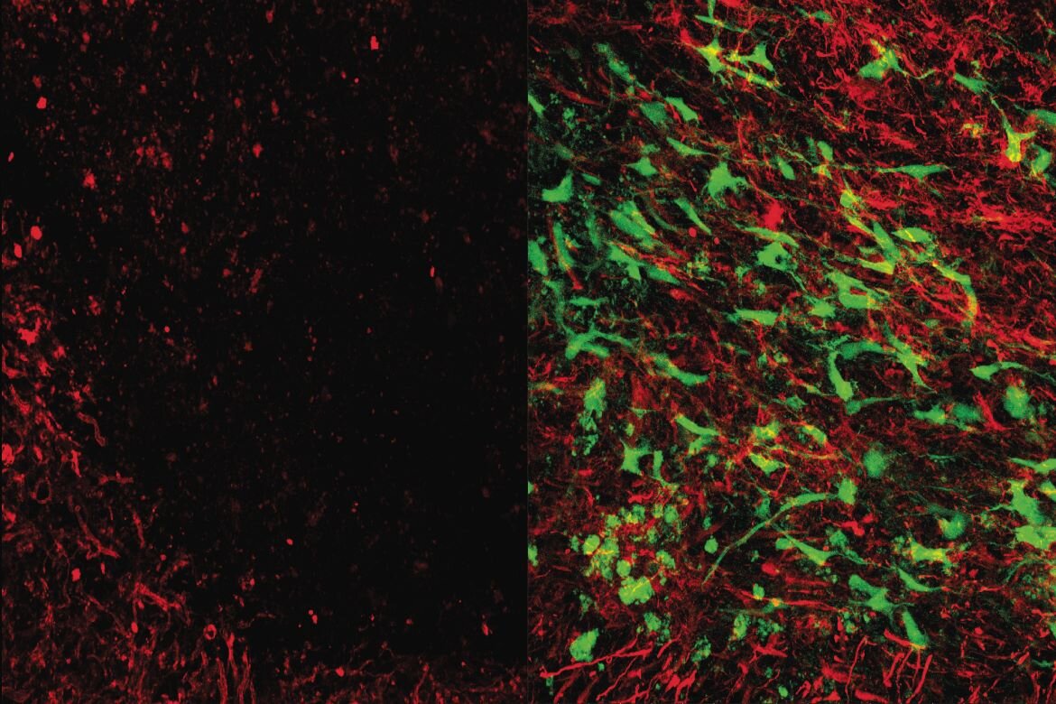 La terapia con células madre ayuda a recuperarse del accidente cerebrovascular y la demencia en ratones