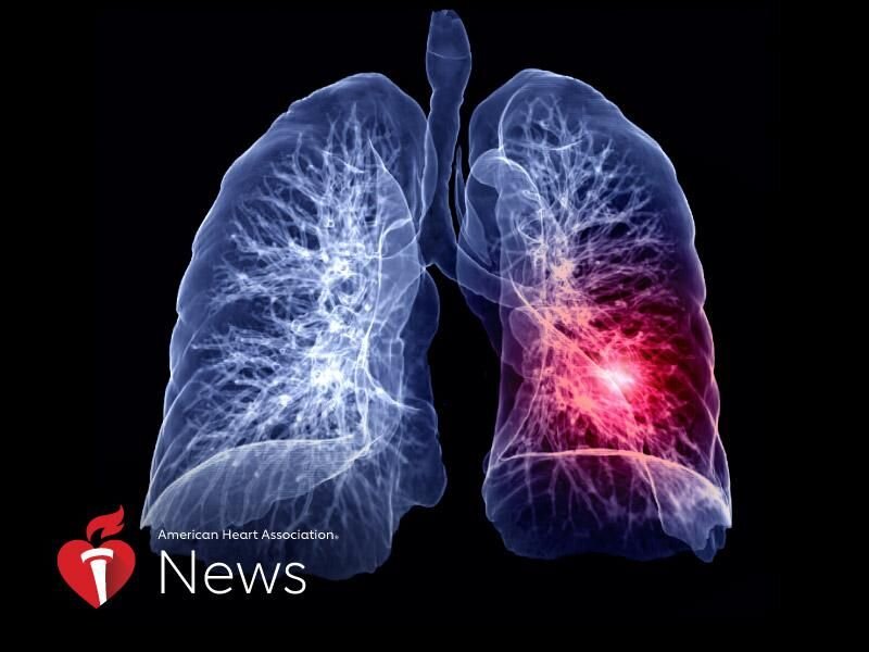 Pulmonary Embolism - The Killer Clot in the Lungs • MyHeart