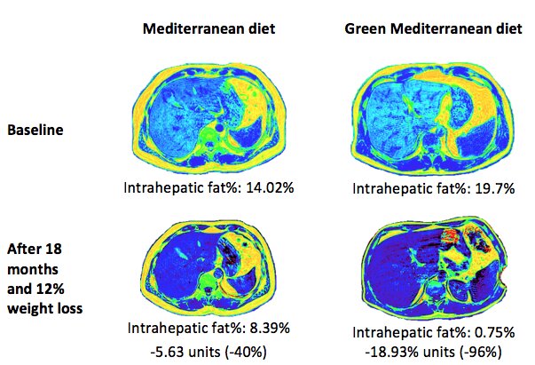 A green Mediterranean diet reduces non-alcoholic fatty liver disease by half