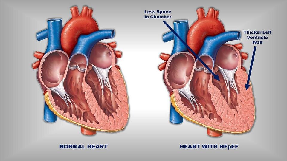 morbidly obese heart vs normal heart