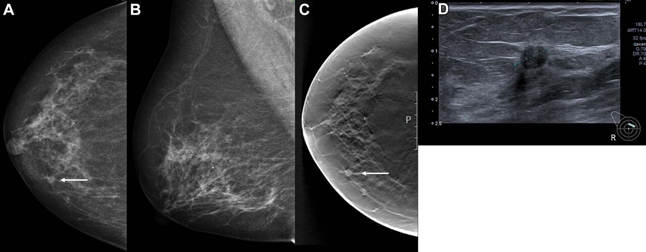 AI shows major promise in breast cancer detection, new studies