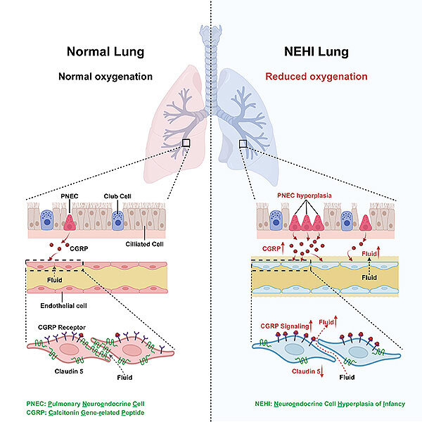 Excess neuropeptides disrupt lung function in infant disease and COVID-19