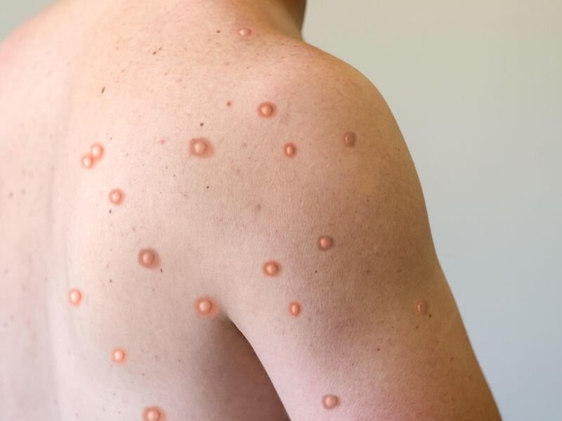 #Fewer symptoms for mpox infection seen after vaccination