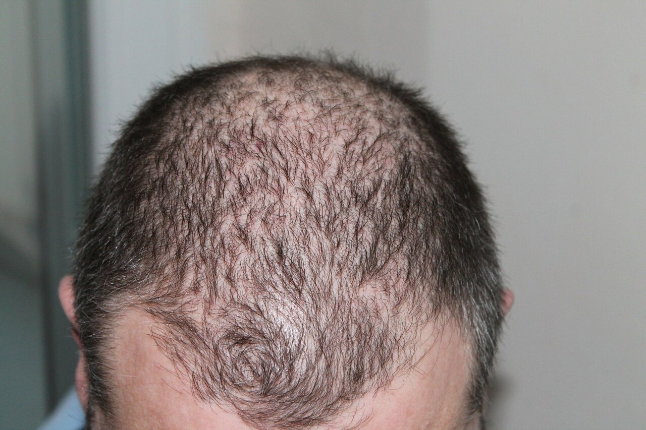 Ranking the efficacy of hair loss drugs