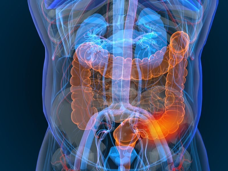 #Heavy antibiotic use tied to development of Crohn’s, colitis