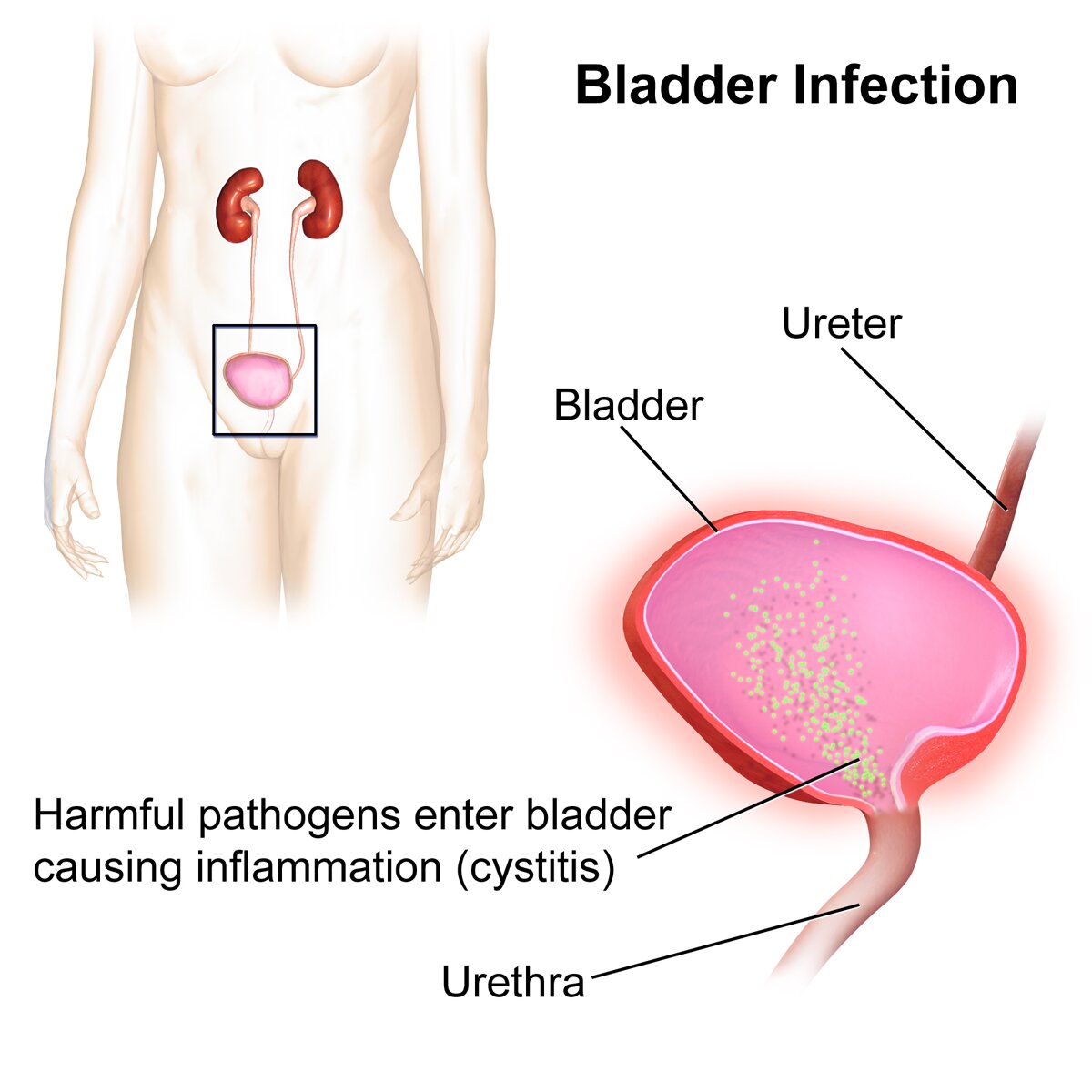 Q&A: How to treat painful bladder syndrome