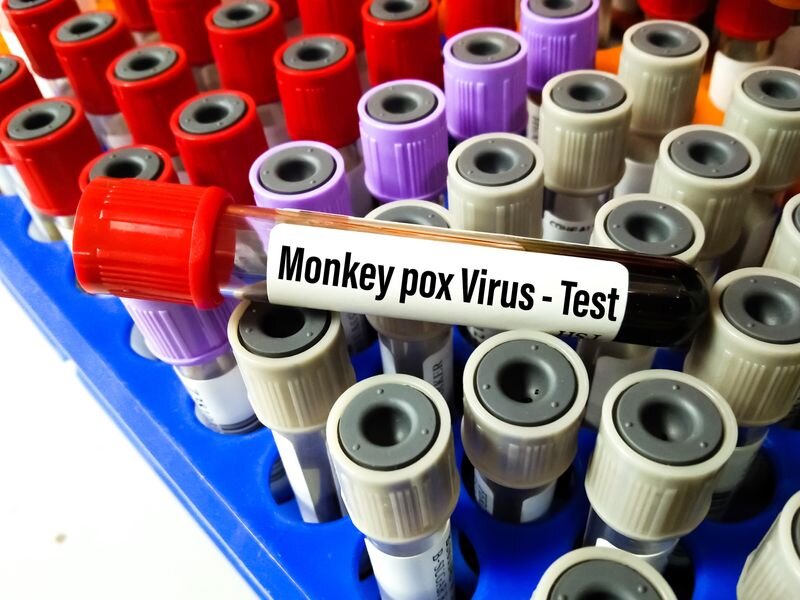 Los Centros para el Control y la Prevención de Enfermedades dicen que los casos de viruela del mono están aumentando lentamente en los Estados Unidos.