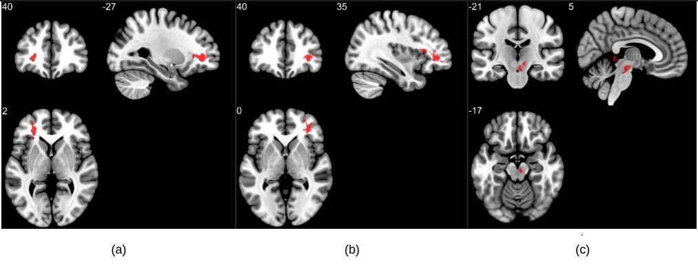 #MRI reveals significant brain abnormalities post-COVID