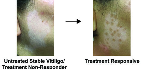 #New study reveals characteristics of stable Vitiligo skin disease