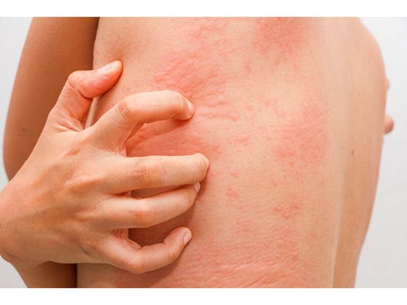 Patients with inflammatory skin diseases have high stress scores