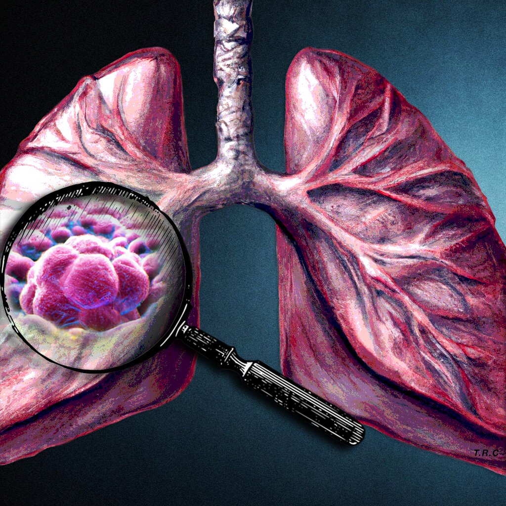 Tumor matrix profiling gives clues to progression of some lung cancers