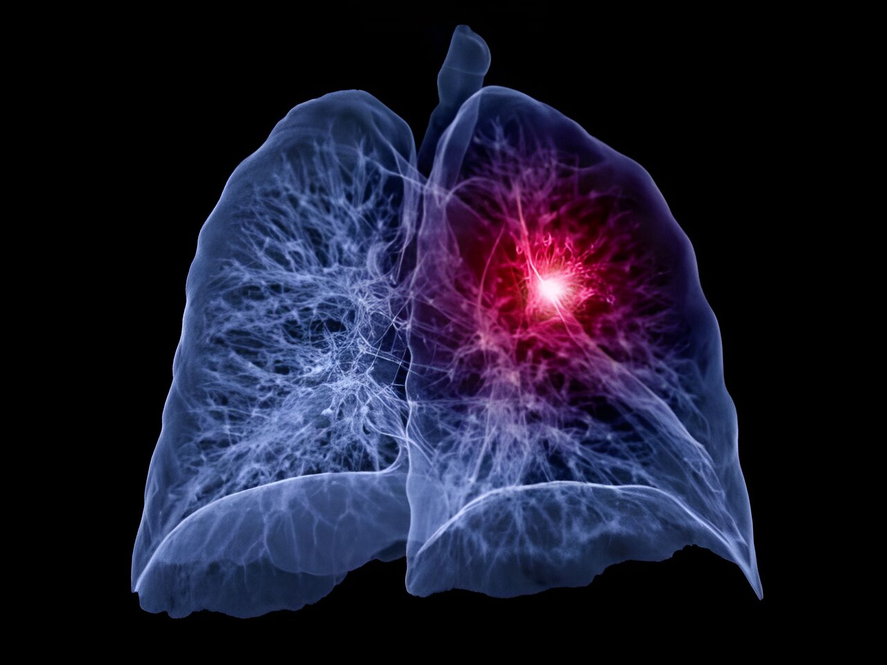 Atezolizumab Monotherapy Beneficial For Non Small Cell Lung Cancer