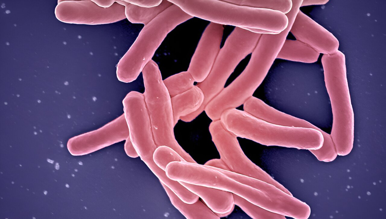 Tuberculosis Bacteria Also Present in 90% of Those with Symptoms, Who Are Not Diagnosed with TB