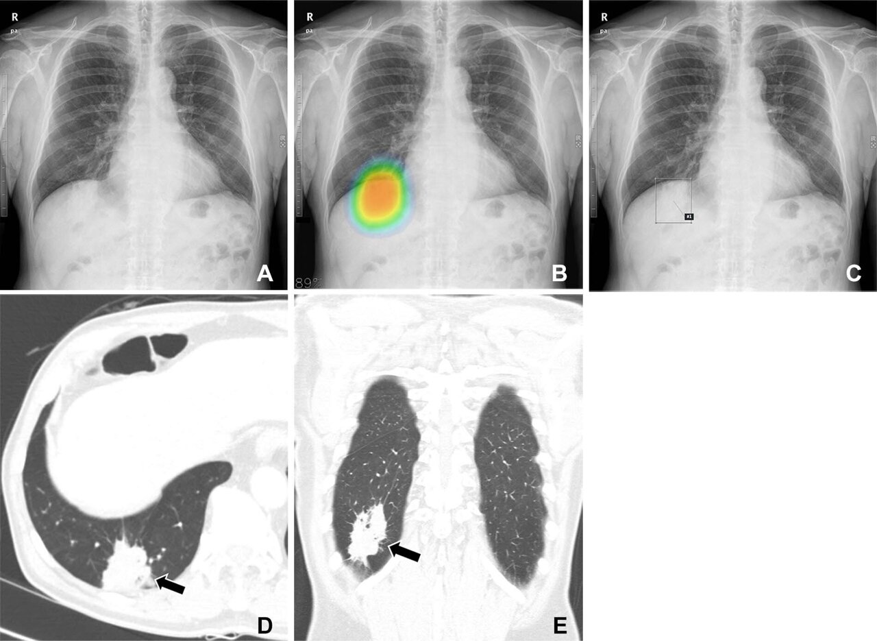 A.I. Took a Test to Detect Lung Cancer. It Got an A. - The New