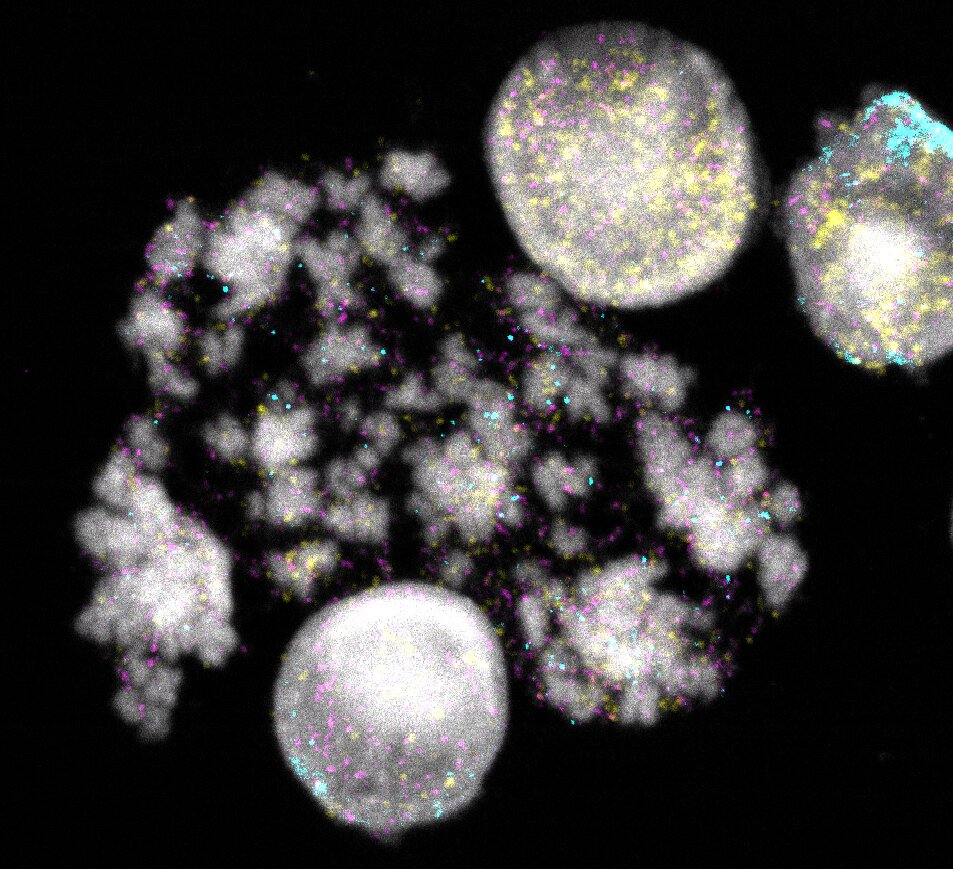 Study sheds light on the mysterious evolution of DNA rings in tumors