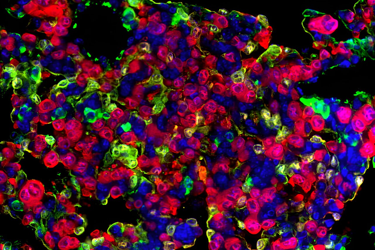 Lung cancer cells’ ‘memories’ suggest new strategy for improving treatment