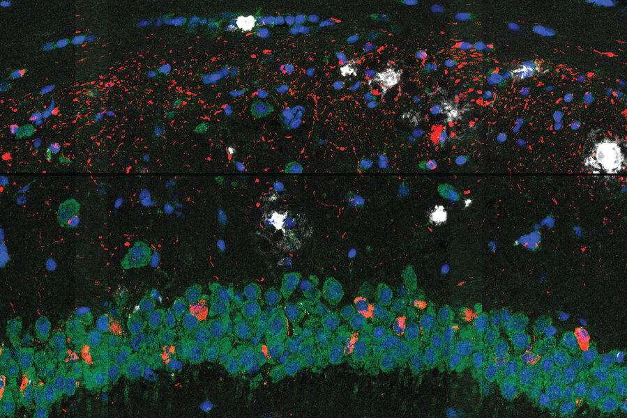 #Researchers map brain cell changes in Alzheimer’s disease