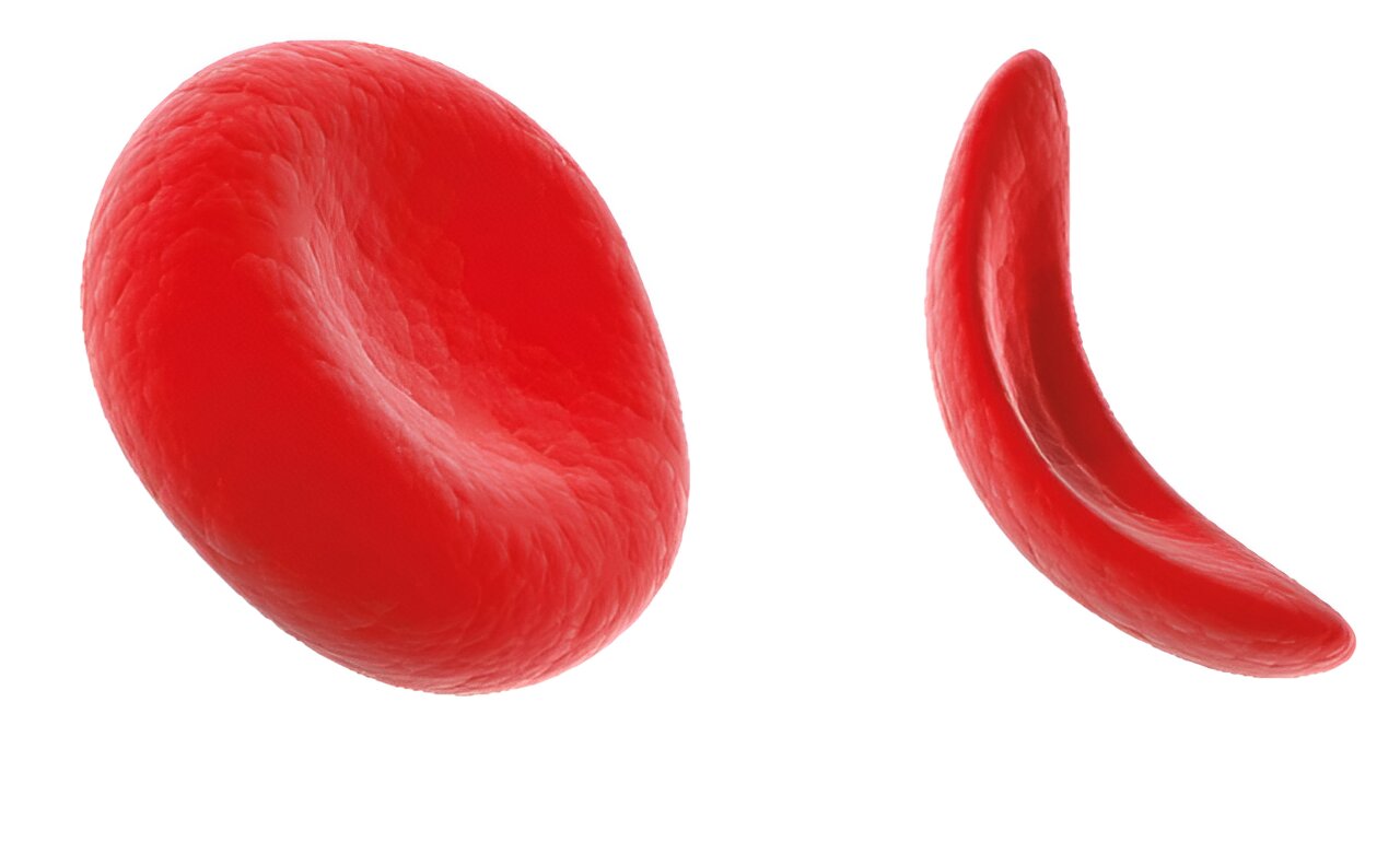 Sickle cell disease continues to face underfunding and lack of research, say researchers