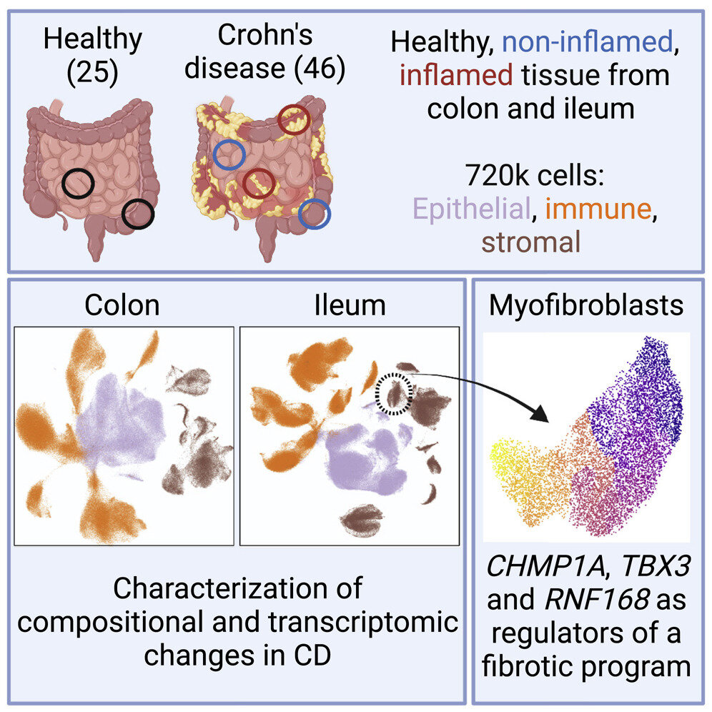 Single-cell analysis of Crohn's disease reveals a detailed picture of  inflammation in the gut