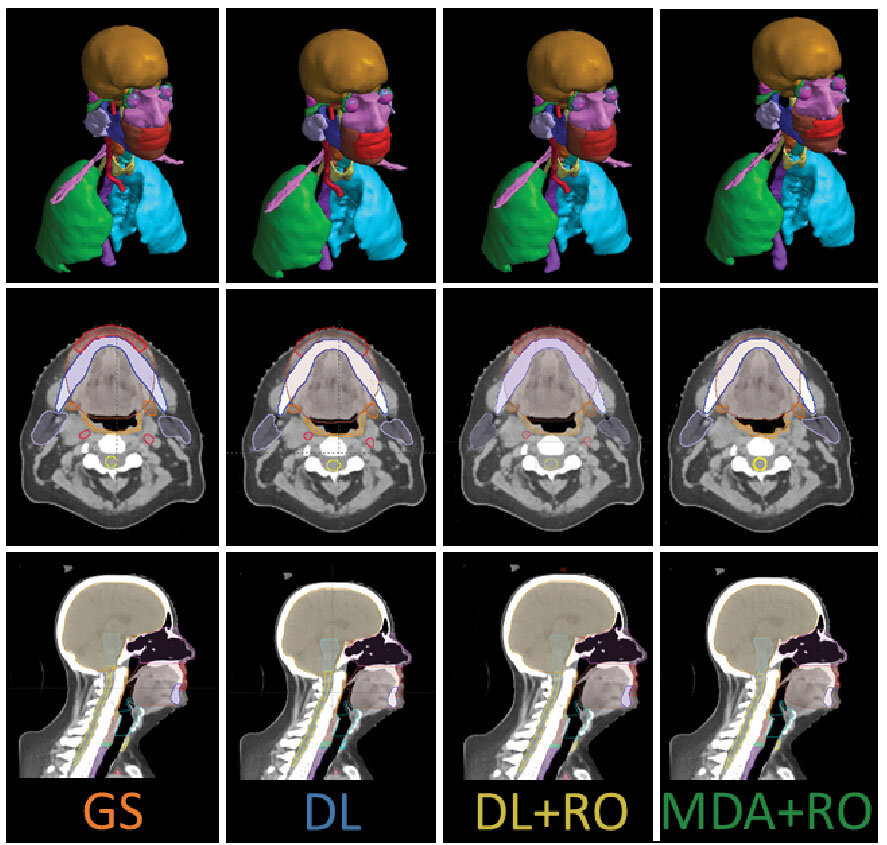 Study suggests improved time efficiency, accuracy with AI-automated head and neck radiotherapy model