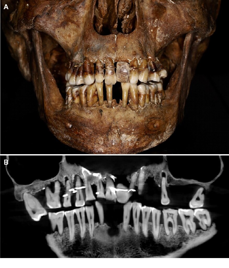 French aristocrat’s golden dental secret revealed 400 years on