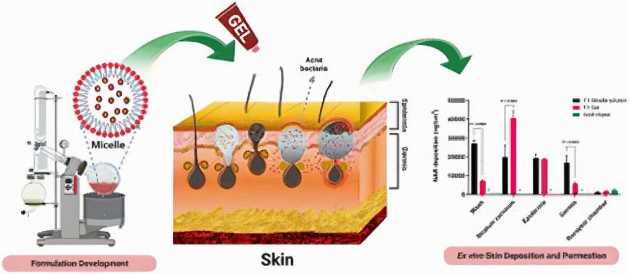 Read more about the article Tiny nanocarriers might show to be the magic bullet for zits victims