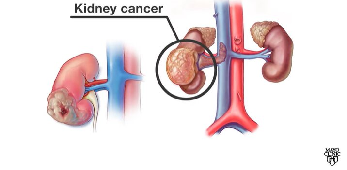 Video: How is kidney cancer treated? - current events in healthcare 2022 - Health - Public News Time