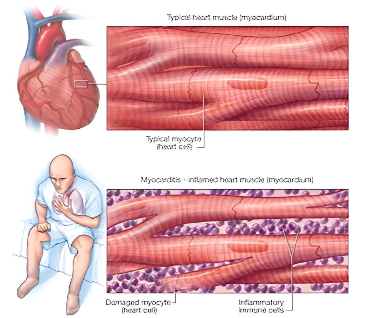 Заболевания мышечной ткани. Воспаление сердечной мышцы. Воспаление мышцы сердца.
