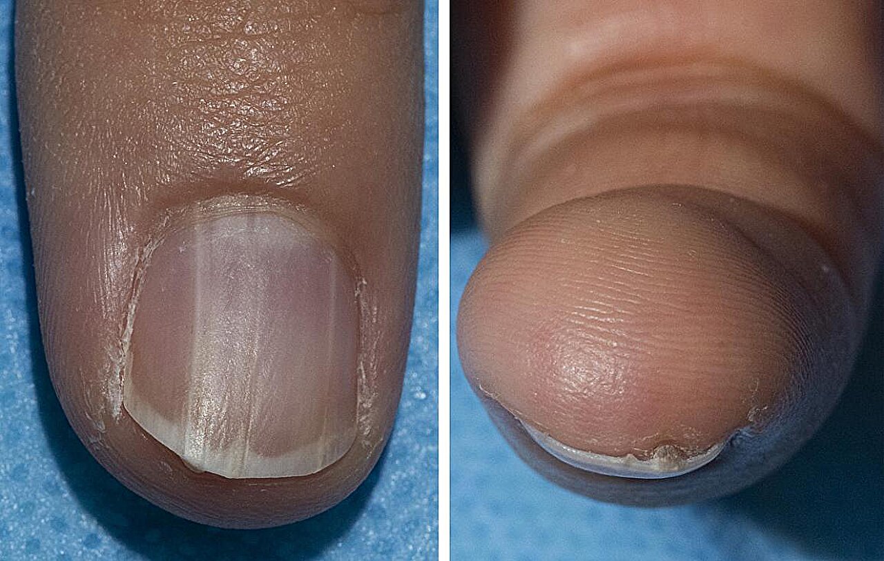 benign nail condition