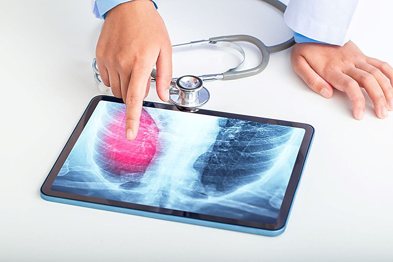 CT-based radiomics nomogram can ID RA-linked interstitial lung disease